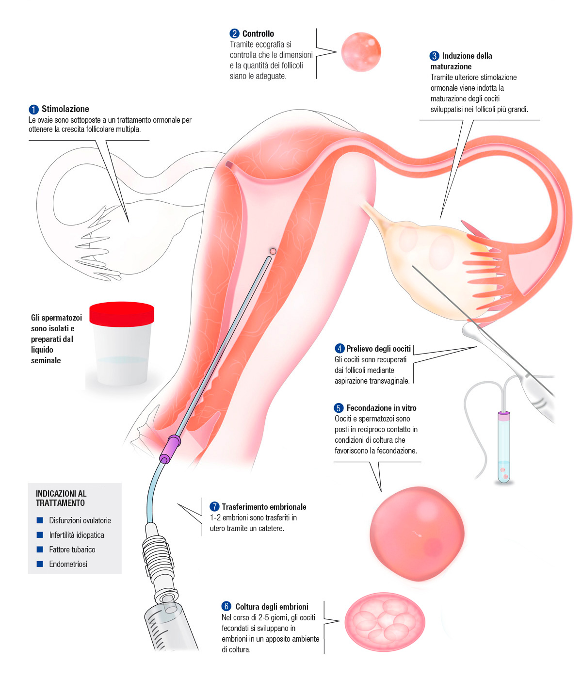 FECONDAZIONE IN VITRO