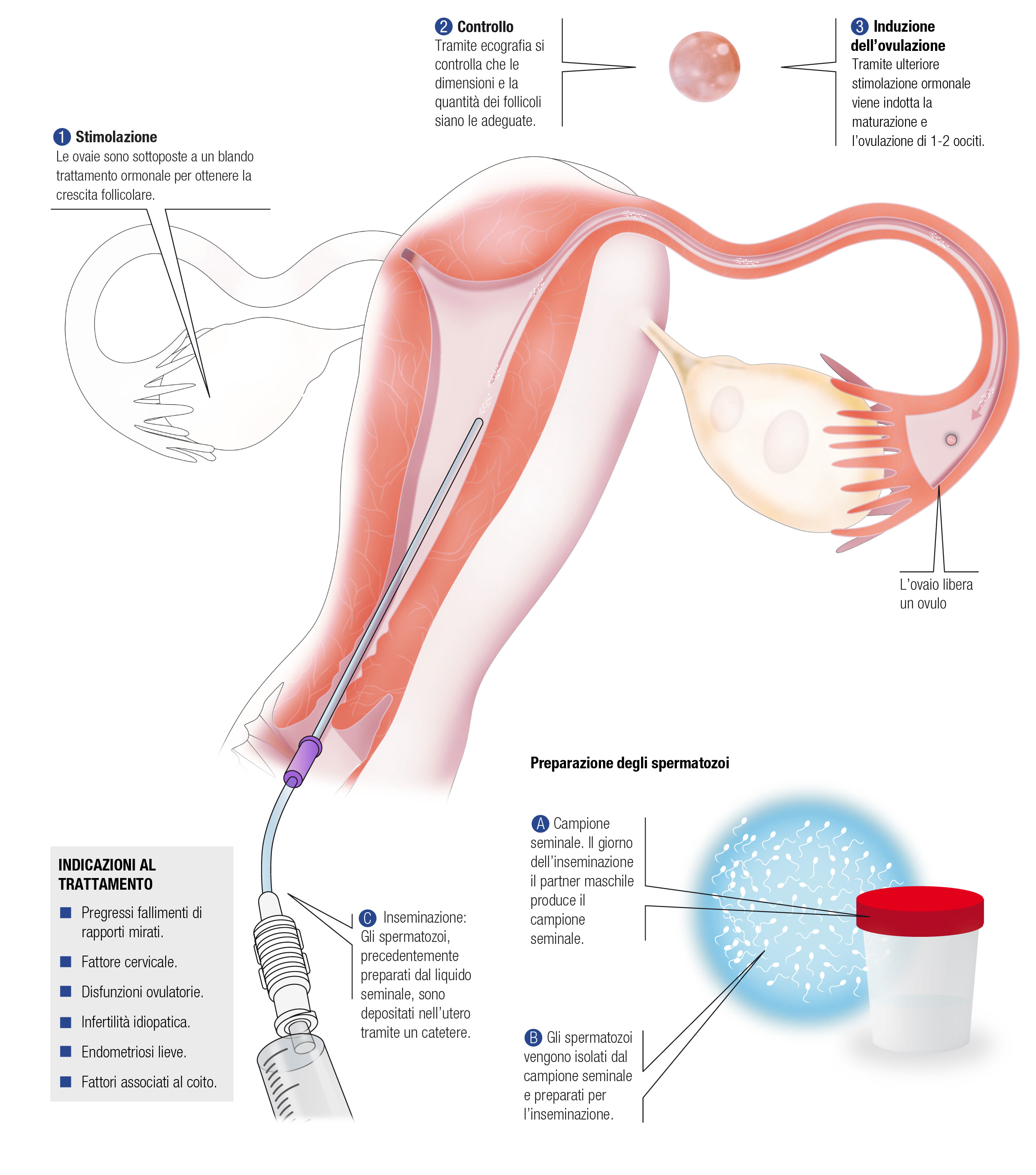 INSEMINAZIONE INTRAUTERINA (IUI)